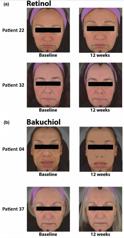 Bakuchiol Benefits For Skin: A Potential Alternative To Retinol