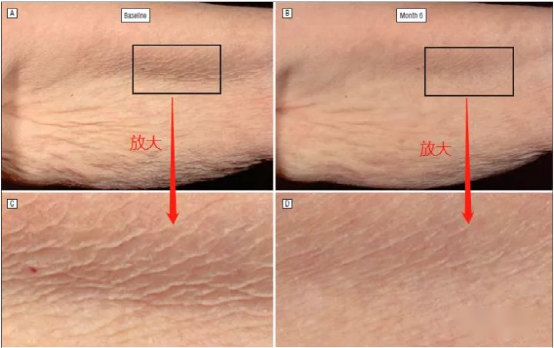 Figure 3. After 24 weeks of use retinol, the subjects' fine lines decrease