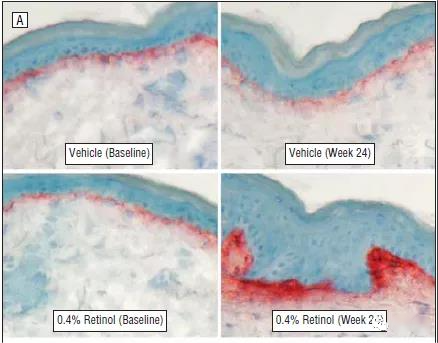 Figure 4. After 24 weeks of use retinol, collagen I of the subjects’ skin increase