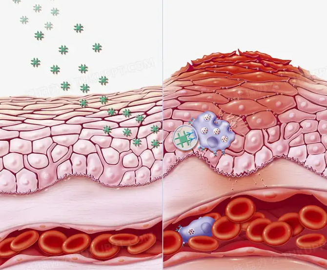 inflammation