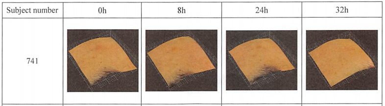 human anti-acne test