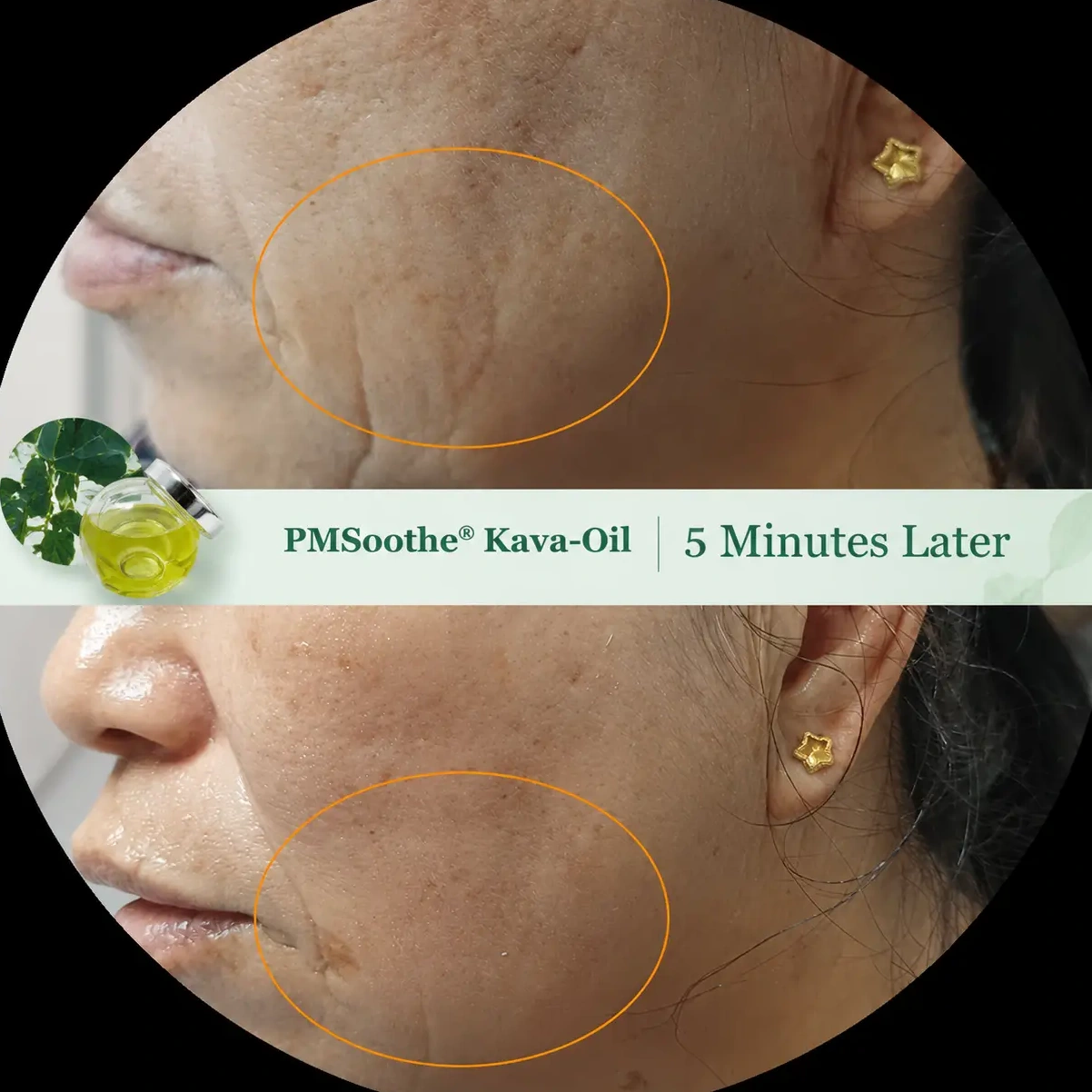 Before-and-after comparison of facial expression lines and skin texture, highlighting the visible changes after 5 minutes of PMSoothe® Kava-Oil application.